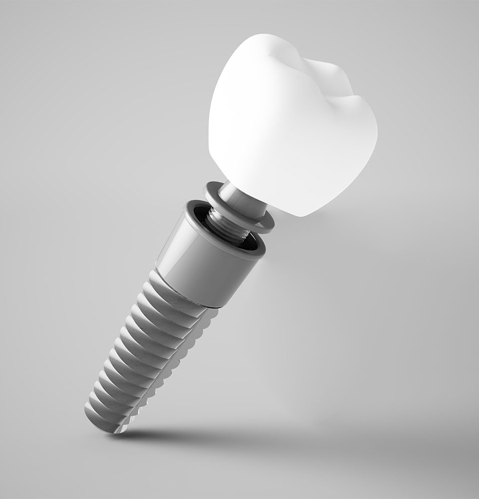 an image of a dental implant.