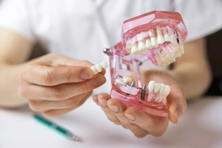 dentist implantologist showing dental bridge implant technology on human tooth jaw model