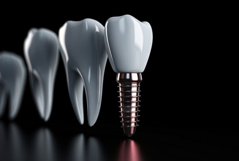 Digital model of a dental implant on a blacked out background