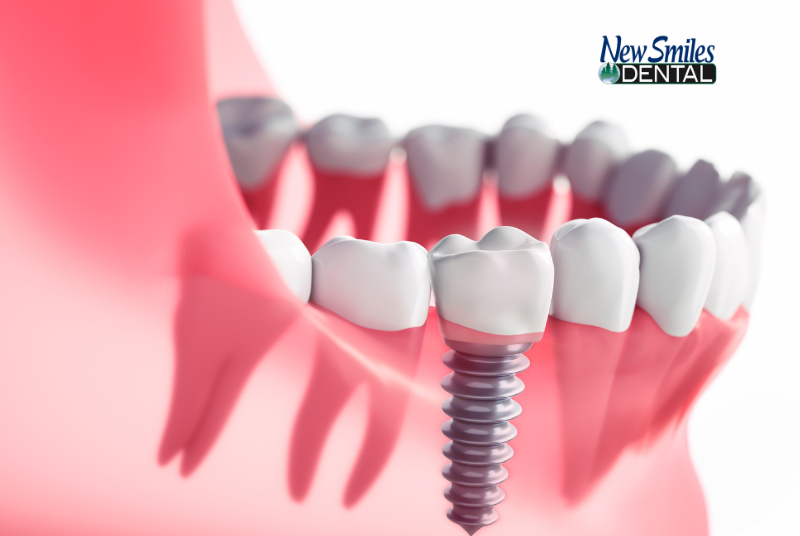 Guide to Dental Implants