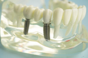 2 single dental implants wiht a clear model to hold it together