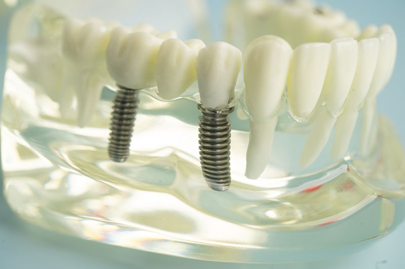 2 single dental implants wiht a clear model to hold it together