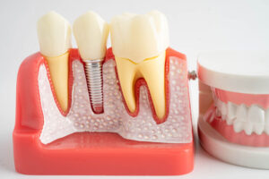 a single dental implant with a full arch model next to it