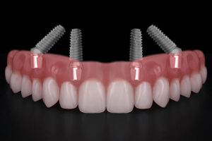 all on 4 dental implants with a full arch of teeth going across it
